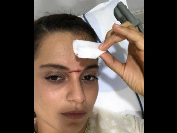 കങ്കണയുടെ പരിക്ക്